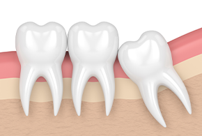 간단 수술 발치