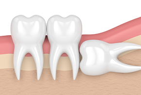 복잡 수술 발치